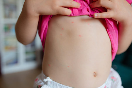 Little girl with chickenpox on her body. Child with chickenpox.