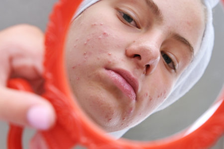 sad teenage girl. Problematic skin in adolescents.の写真素材