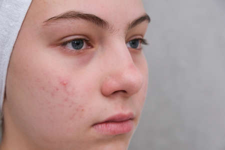 acne. Teenage girl with the pimples on her face. close-up. Problematic skin in adolescents.の写真素材