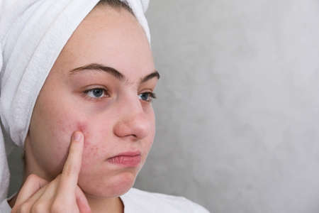 A teenage girl points her finger at the pimples on her face. acne. problematic skin. facial skincare.の写真素材