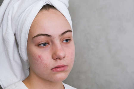 teenage girl with acne on her face.の素材 [FY310184004032]