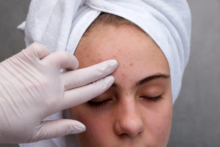 Acne. Teenage girl with the pimples on her face. Problematic skin.