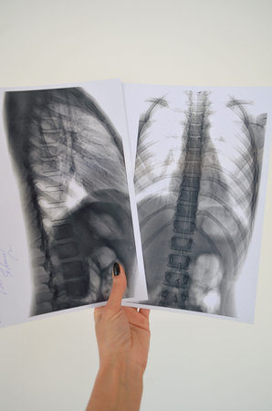 Spine Rengen picture