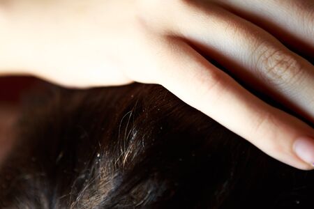 Unhealthy head skin with dundruff and gray hairの写真素材