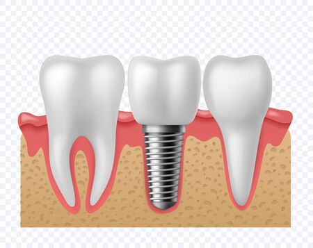 Tooth implant. Human teeth and dental implant, denture orthodontic technology. Artificial teeth dentistry implantation jaw. stomatology vector concept isolated oのイラスト素材