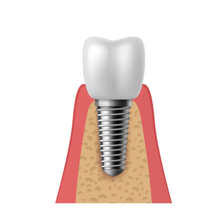 Realistic tooth implant. 3D denture orthodontic implantation teeth, implant structure pictorial models crown. Prosthetics in stomatology clinic concept vector isolated on white background illustrationのイラスト素材