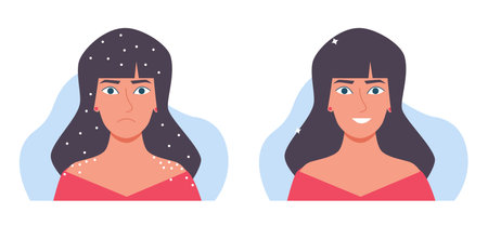 Sad woman with flake on head and shoulders and joyful woman without dandruff. Dry scalp problem. Disease of skin, health and scratching hair. Cartoon flat style isolated vector conceptのイラスト素材