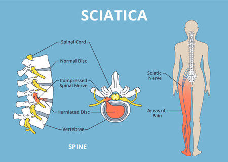 Sciatica pain scheme. Health care medical anatomical poster, vertebrae, spine and spinal cord, herniated disk, education banner design, human silhouette, nowaday vector anatomy infographicsのイラスト素材