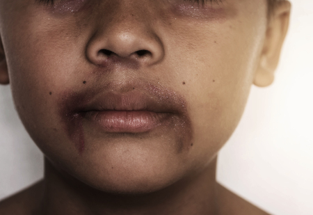 bruise on boy's face, after abuse on white, child abuse conceptの写真素材