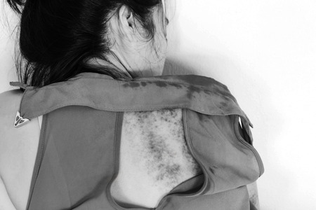 bruises on body, Sexual violence , sexual abuse, human trafficking with shadow edge  in white toneの写真素材