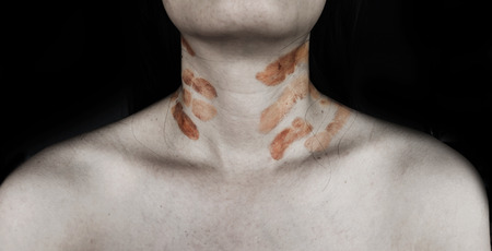 bruise on body of woman (abuse concept) on blackの写真素材