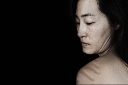 bruise on body of woman (abuse concept) on blackの写真素材