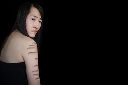 bruise on arm of woman (abuse concept) on white in white tone