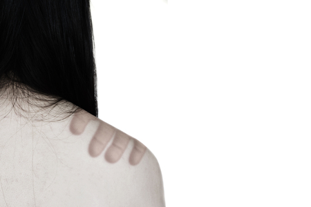 bruise on body of woman (abuse concept) isolated on whiteの写真素材