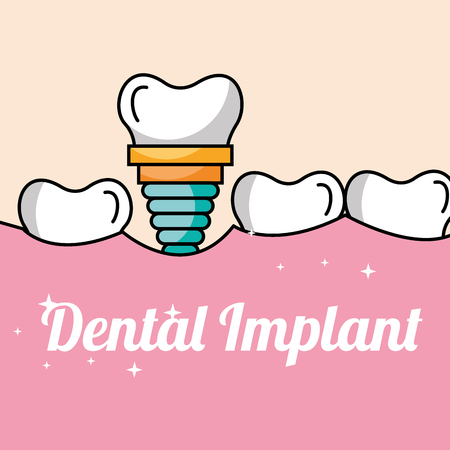 dental implant tooth and gum inside mouth vector illustrationのイラスト素材