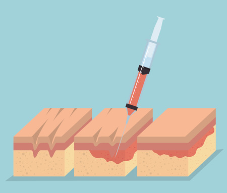 layers of skin with injection vector illustration designのイラスト素材