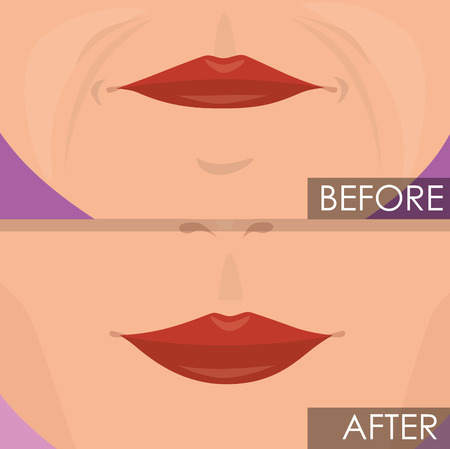 woman lips before and after treatment vector illustration designのイラスト素材