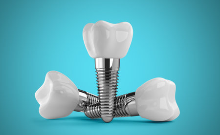 dental implants on a blue background. 3d rendering.の写真素材
