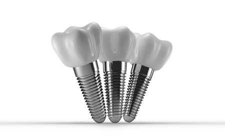 dental implants isolated on a white background. 3d rendering.