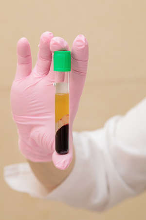 A test tube with blood plasma in the hand of a specialist. Plasmoliftingの写真素材