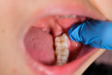 Wisdom teeth affect and cause gum recession.の写真素材