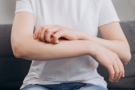 Close up of young caucasian female with allergic reaction from atopic, insect bites on her arm, hand in scratching itchy, itch red spot or rash of skin. Healthcare, treatment, dermatology conceptの写真素材