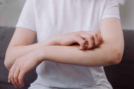 Close up of unknown ill young woman with allergic reaction from atopic, insect bites on her arm, hand in scratching itchy, itch red spot or rash of skin. Healthcare, treatment, dermatology conceptの写真素材