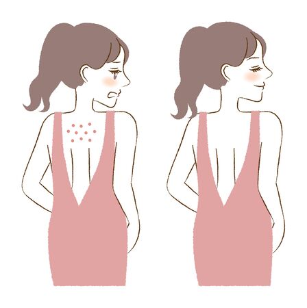 A woman with acne on her backのイラスト素材
