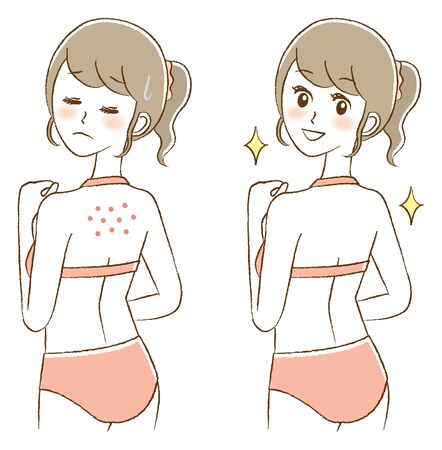 Illustration of a Woman Suffering from Acne on the Backのイラスト素材