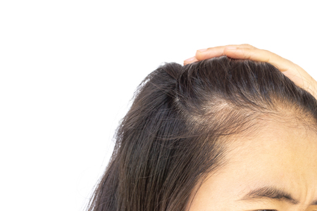 Woman serious hair loss problem for health careの写真素材