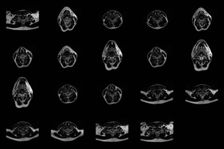 set of transverse MRI scans of neck area of caucasian male with bilateral paramedial extrusion of the C6-C7 segment with radiculopathyの写真素材