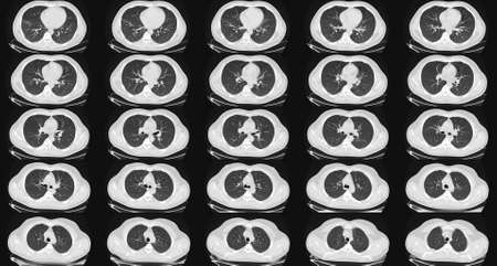 Computed tomography of the lungs in a healthy adult man. Normal lungs ct scan. May be part of...