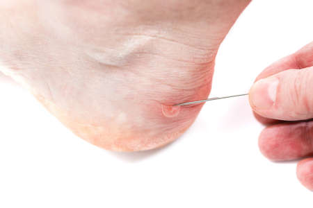 Blister on heel gets pricked with needle to burst it on white background, close-up with selective focus.の写真素材