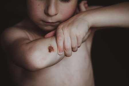 The boy examines the abrasion on his elbow.の写真素材