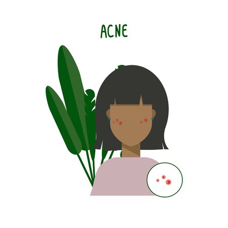 Illustration of a beautiful girl with acne. Young woman and foliage behind. Girl shows her skin and face. Vector illustration, skin features.のイラスト素材