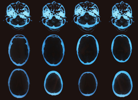 X-ray image of the brain made using computed tomographyの写真素材