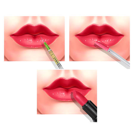 Hyaluronic acid filler injection or mesotherapy procedures. Beautiful red female lips. Vector artのイラスト素材