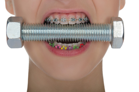 Teeth with braces colored compressed metal screwの写真素材