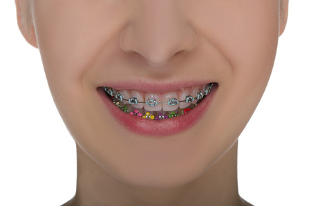Closeup of smiling mouth with braces on teeth isolated on whiteの写真素材