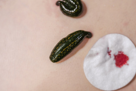 Close up of a medical leeches on his stomach in the liver area and the navel.の写真素材