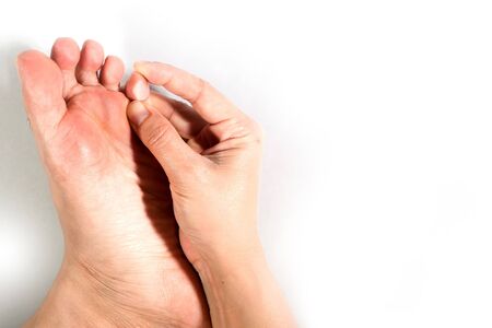 Close up of peeling and blister foot. Causes of morbidness foot with water inside (athlete's foot), dehydration or sweaty feet. Health care concept.の写真素材