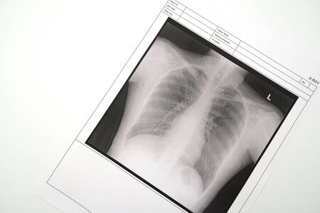 Lung x-ray To check for Covid 19 viruses or coronavirus .using as background Healthcare concept and Medical concept with copy space.の写真素材