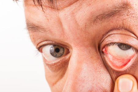 A man pulls his lower eyelid with his finger downの写真素材