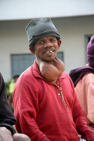 KOLKATA INDIA - JANUARY 26: Streets of Kolkata. Portrait of sick man on January 26, 2009 in Kolkata, India.のeditorial素材