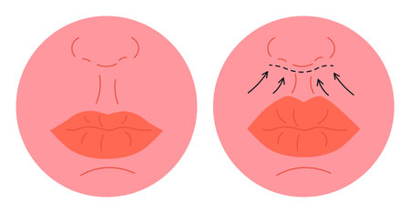 Lip Lift Surgery Before and After Illustration.のイラスト素材