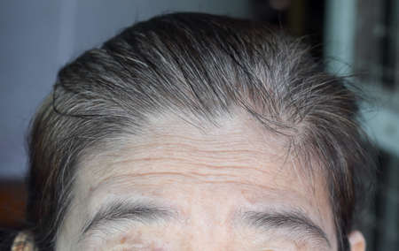 Skin creases or wrinkles at forehead of Southeast Asian, Myanmar or Burmese elder woman. Symptom of...