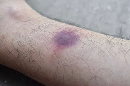 Bruise in right leg of Asian Burmese male patient. Lateral view.