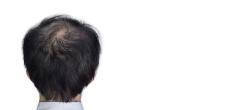 Thinning or sparse hair, male pattern hair loss in Southeast Asian, Chinese elder man. With text...