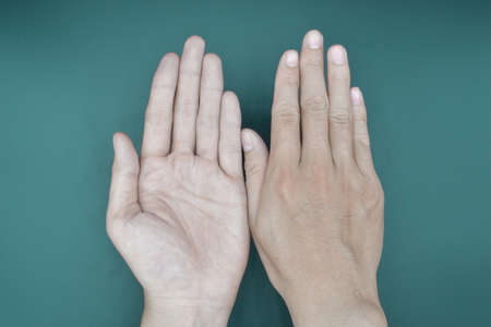 Pale palmar surface of both hands. Anaemic hands of Asian, Chinese man. Isolated on green background.の写真素材