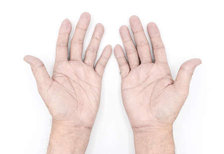 Pale palmar surface of both hands. Anaemic hands of Asian, Chinese man. Isolated on white background.の写真素材
